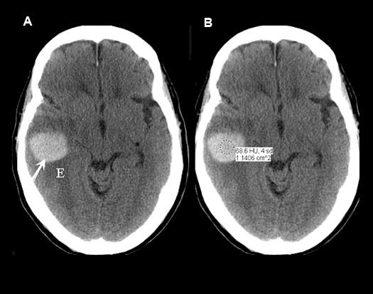 Head CT - hemorrhage
